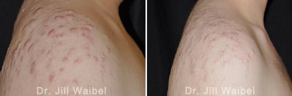 ACNE SCARS - Before and After Treatment Photos - Raised Acne Scar -body (right side view)
