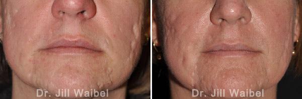 ACNE SCARS - Before and After Treatment Photos - face (frontal view)