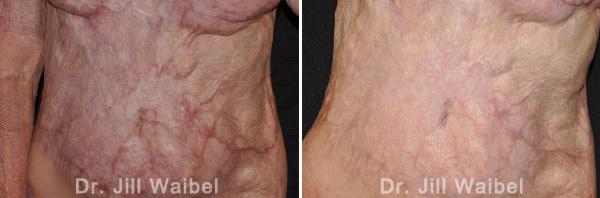 BURN SCARS - Before and After Treatment Photos: female (body, frontal view)