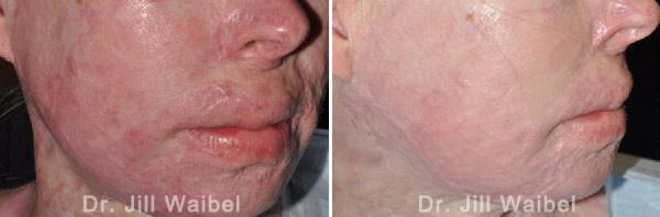 BURN SCARS - Before and After Treatment Photos: female (face, oblique view)