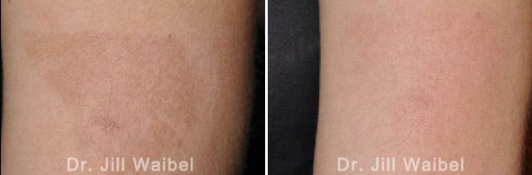BURN SCARS: Before and After Treatment Photos - leg 