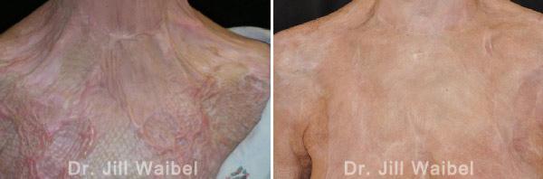 BURN SCARS: Before and After Treatment Photos - body (neck, breast)