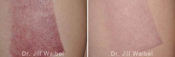 BURN SCARS. Before and After Treatment Photos