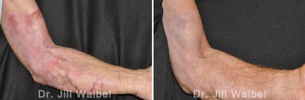 BURN SCARS - Before and After Treatment Photos: male (hand, side view)