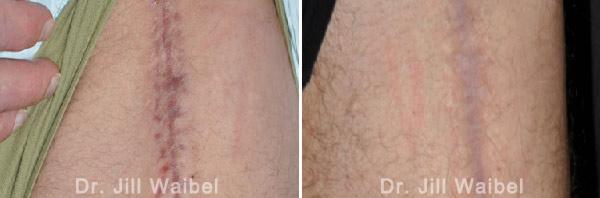BURN SCARS - Before and After Treatment Photos: body
