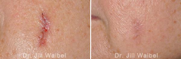 SURGICAL AND COSMETIC SCARS. Before and After Treatments Photos: female (face)