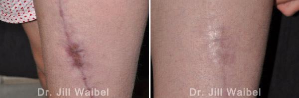 SURGICAL AND COSMETIC SCARS - Before and After Treatments Photos - leg (left side view)