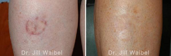 SURGICAL AND COSMETIC SCARS. Before and After Treatments Photos: leg