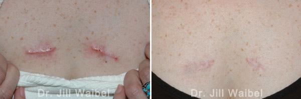SURGICAL AND COSMETIC SCARS. Before and After Treatments Photos: breast