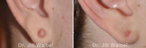 KELOIDS - Before and After Photos: woman (ear, side view)