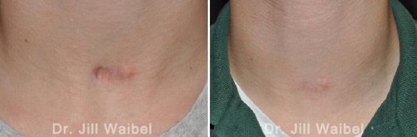 TRAUMATIC SCARS. Before and After Treatments Photos - neck