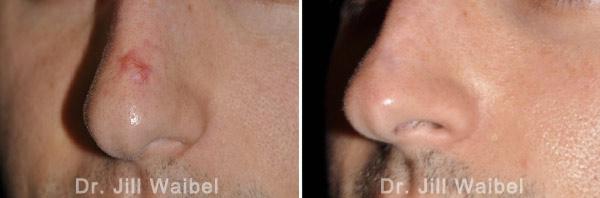 TRAUMATIC SCARS. Before and After Treatments Photos - nose
