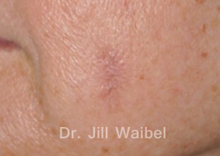 SURGICAL  AND COSMETIC SCARS. After Treatment Photo: female (left side view)