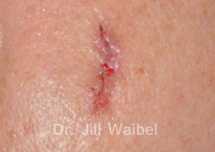 SURGICAL  AND COSMETIC SCARS. Before Treatment Photo: female (left side view)