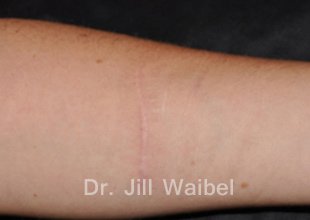SURGICAL  AND COSMETIC SCARS. After Treatment Photo: hand