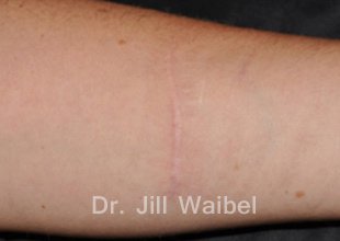 SURGICAL  AND COSMETIC SCARS. After Treatment Photo - hand
