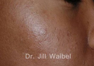 ACNE SCARS: After Treatment Photo - face (oblique view)