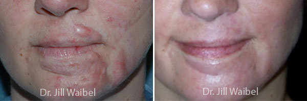 Hypertrophic Scar Treatment. Before and After Treatments Photos: female (face)